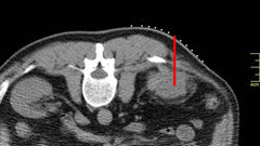 The Fast Find Grid - CT Guided Biopsy Grid