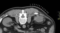 The Fast Find Grid - CT Guided Biopsy Grid